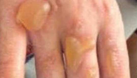 hand_sanitiser_burns_warning_web.jpg hand_sanitiser_burns_warning_web.jpg