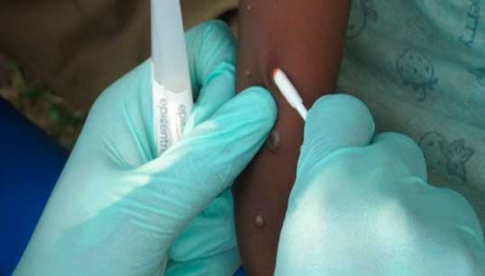 Monkeypox sampling. Image: Wikimedia Commons Image:Monkeypox sampling. Image: Wikimedia Commons